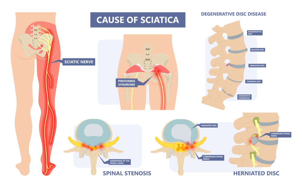 Can Chiropractic Relieve the Piriformis Syndrome?