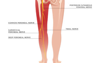 Sciatica Causing Back Pain